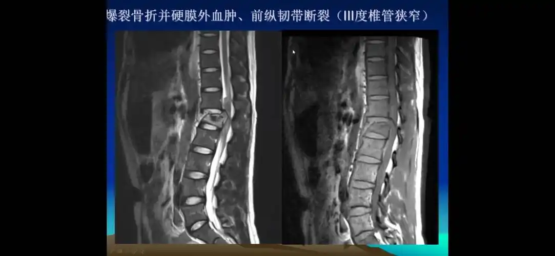 胸腰椎骨折ct影像学表现