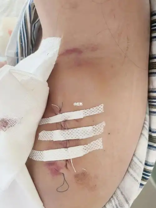 锁骨骨折术后第二天