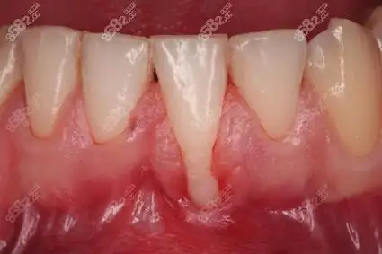 我们可以看到牙冠和埋在骨头里面看不到牙根,牙龈包裹着牙槽骨和牙冠