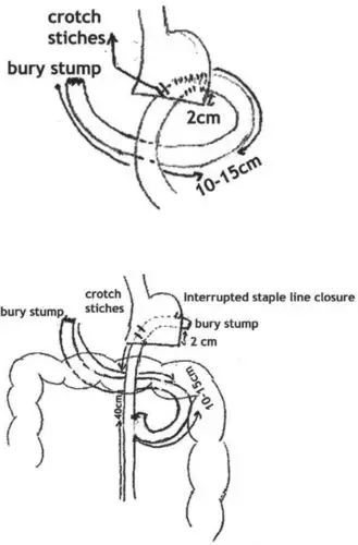 ry式还是bii式根治性远端胃大部切除术后胃肠重建的选择