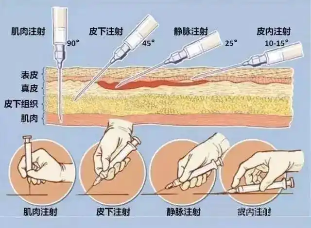 7无痛注射穿刺方法皮肤痛觉神经纤维大多数分布于表皮,其痛觉感受器呈