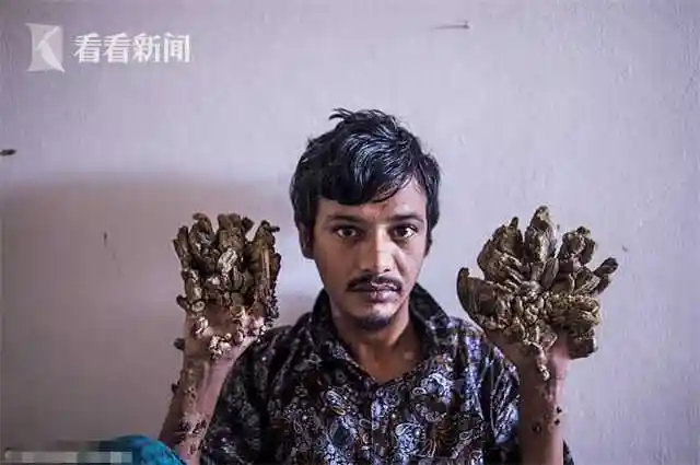 视频25次手术切完又长男子双手如枯树枝苦求截肢