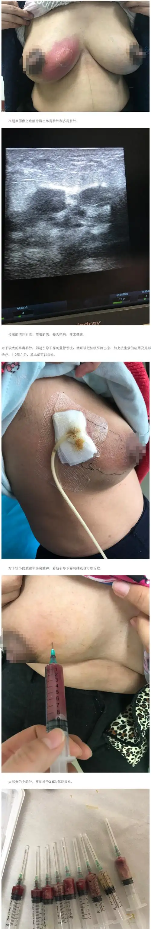 超声引导下穿刺治疗乳腺炎脓肿 - 好大夫在线