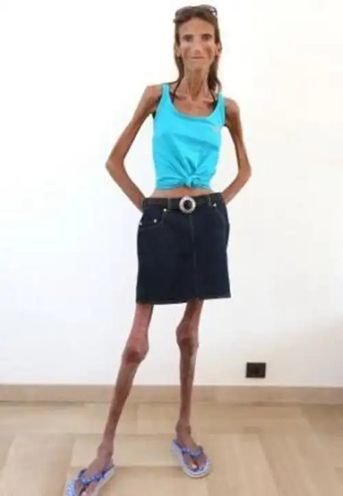 美女节食20年如木乃伊 皮包骨的那些纸片女(图)