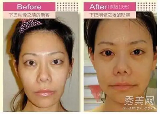 整容界10年20万人毁容 哪些明星是受害者?