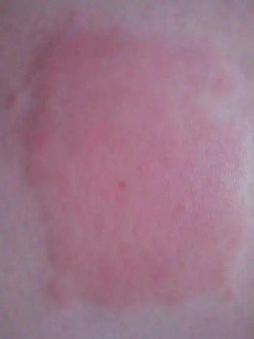 问:贴完药膏后皮肤突然红肿 还特别痒 不知道该抹什么药