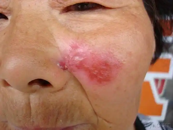 看图诊断9公布答案盘状红斑狼疮