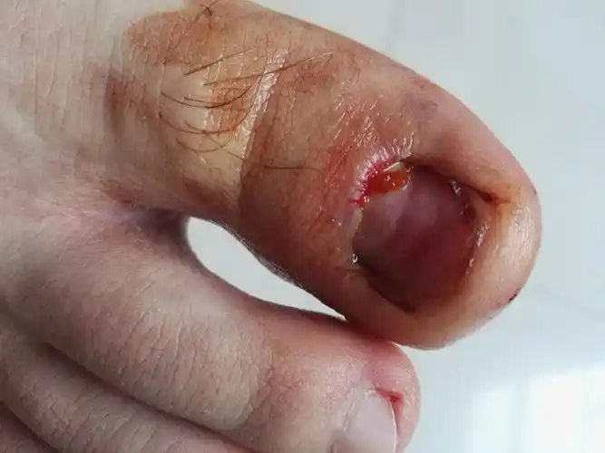 拔指甲是什么样的体验?很疼么?