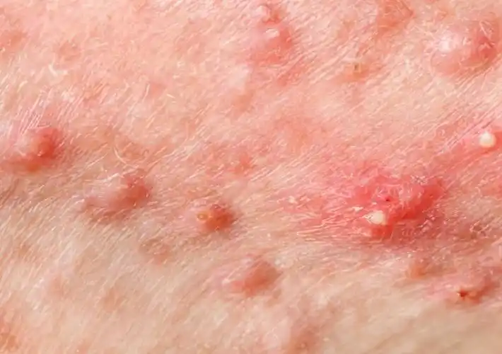 念珠包皮炎图片 (33)