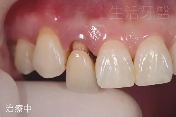 台中牙医推荐 侧门牙假牙重做全瓷冠合并牙齿居家美白疗程 实际案例