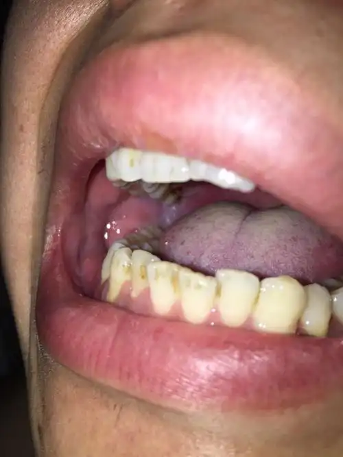 牙龈肿痛.喉咙也痛是什么情况?