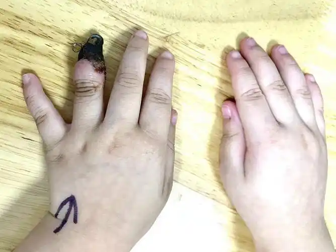 痛心家人错误包扎3岁女童手指被截肢