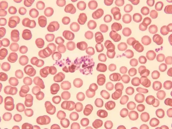 形态学报告中血小板应该如何描述 ?