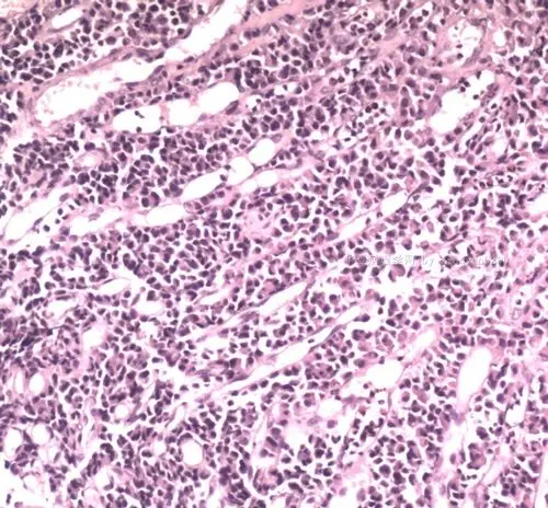 直肠癌? - 专科病理>>消化系统 - 华夏病理网