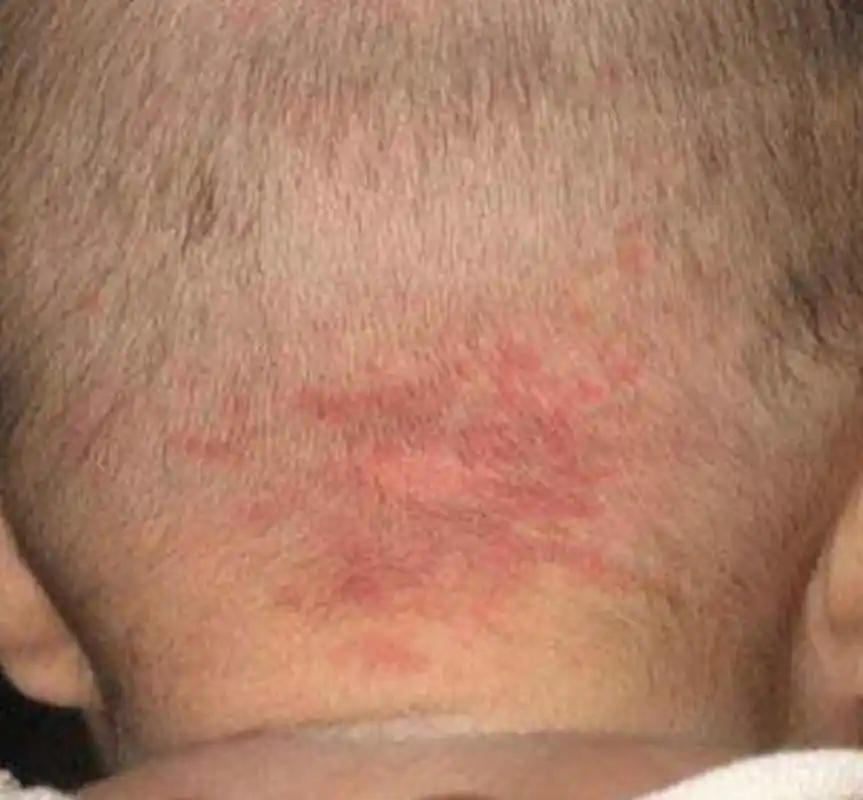 首都儿科研究所皮肤科李倩这个血管瘤叫做"鲜红斑痣",很多家长上网一