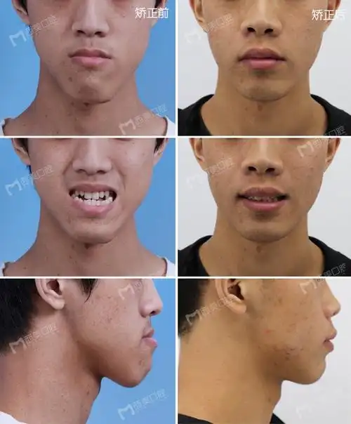 正畸正颌联合矫治案例