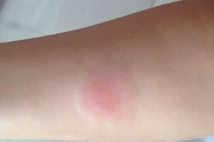 正常人ppd反应图片