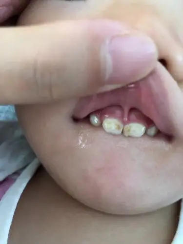 请问了1岁半宝宝牙齿黄有洞洞怎么处理