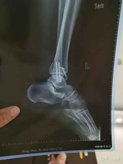 左脚踝两侧骨折恢复记录