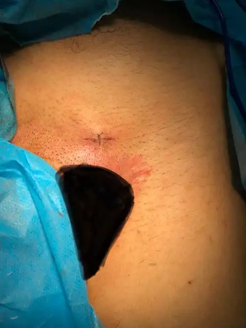 红花岗区人民医院成功开展显微镜精索静脉曲张高位结扎术