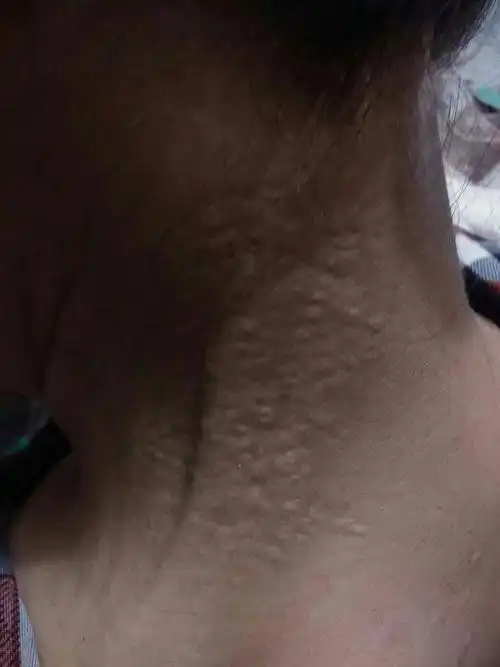 我妈妈的脖子和后背上长了小疙瘩,不疼不痒,以前长过,后来好了,现在又