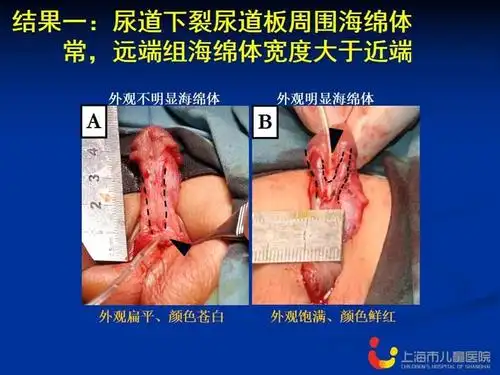 尿道下裂尿道板周围尿道海绵体的组织形态学研究ppt