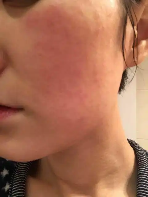 夏天红血丝该如何护理?