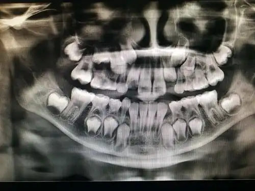 孕妇可能不得不在宝宝出生前拍牙片,因为未经治疗的牙科感染会对胎儿