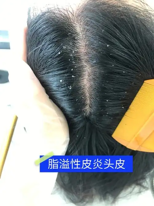 脱发  #头皮护理  #眉山探店  #这家店回头客超多关于头皮脂溢性皮