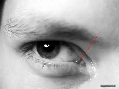 失眠,早晨起床眼角泪阜红肿,如图,这是怎么了,现在很着急