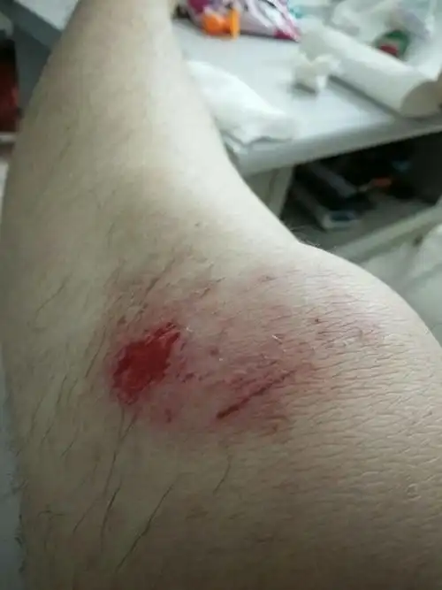 这会不会有什么事 刚骑摩托车摔得 现在腿弯区好疼