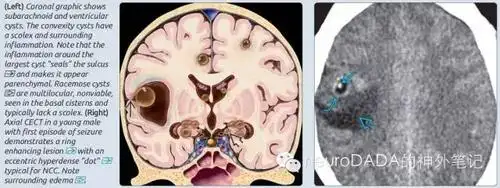 脑绦虫感染就是脑囊虫病吗