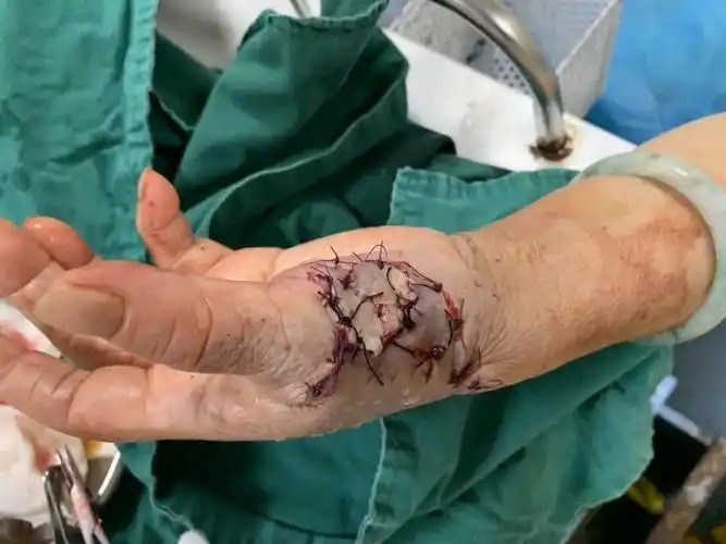 拆开患者左手包扎的纱布检查,发现经过清创缝合后的伤口已经慢慢长回