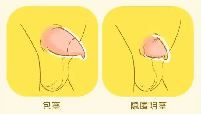 如果是包茎,小鸡鸡整个是在体外的,只是被包皮裹住了,捏着是实心的.
