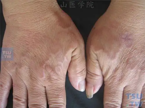 双手背见小而光滑的丘疹,斑块,部分相互融合或密集排列成环状