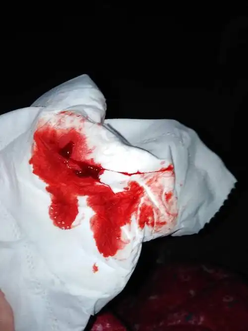 了, 有一段时间了,有想上厕所的感觉但是又便不出来,感觉肛门口堵着