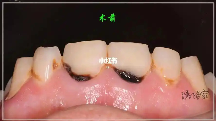 可乐牙树脂充填美学修复