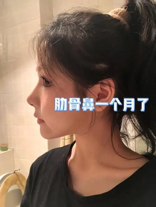 肋骨鼻一个月了