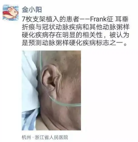 耳垂上有折痕,是心梗的"标志"?辟谣:有一定风险,是该重视