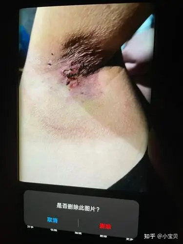 狐臭手术 - 知乎