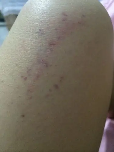 今天突然看见孩子腿上起的,发紫!