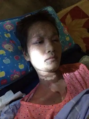 医生给他冶疗.变成这样,现在放在家里等死.