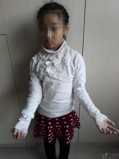 采用佩戴本人自行设计的外翻矫形支具