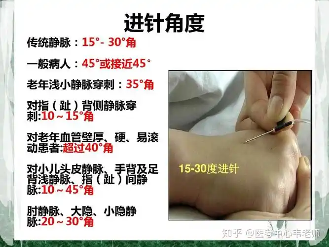 静脉穿刺技巧-后续 - 知乎