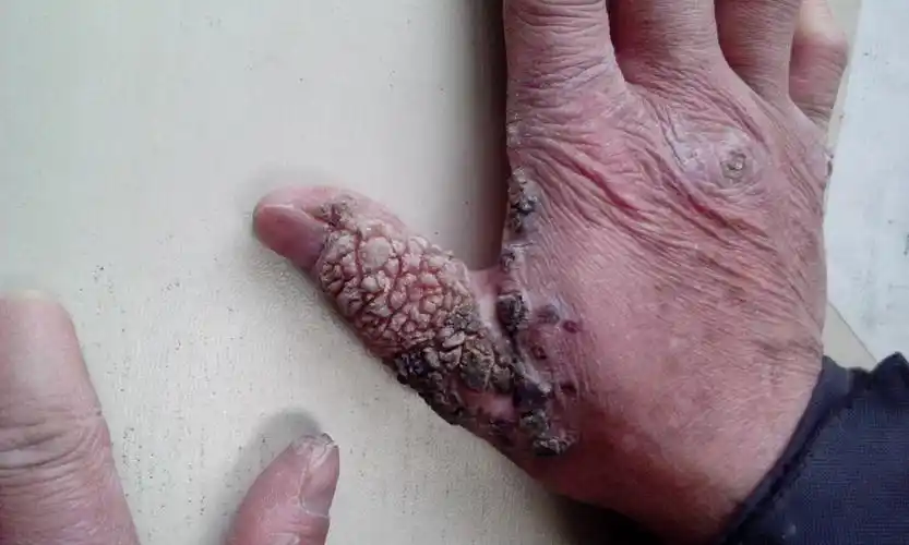 疣状表皮发育不良