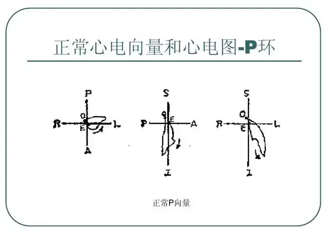 心电向量图基础ppt