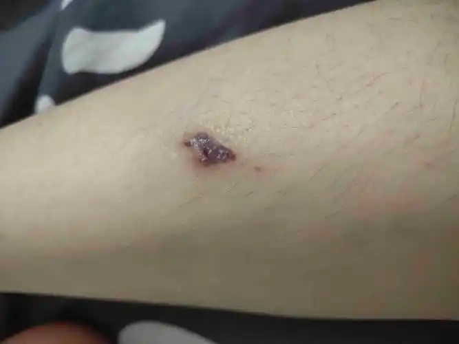 我腿这里是杯子割了个口子,现在伤口愈合脱痂了,但是里面红红的,是
