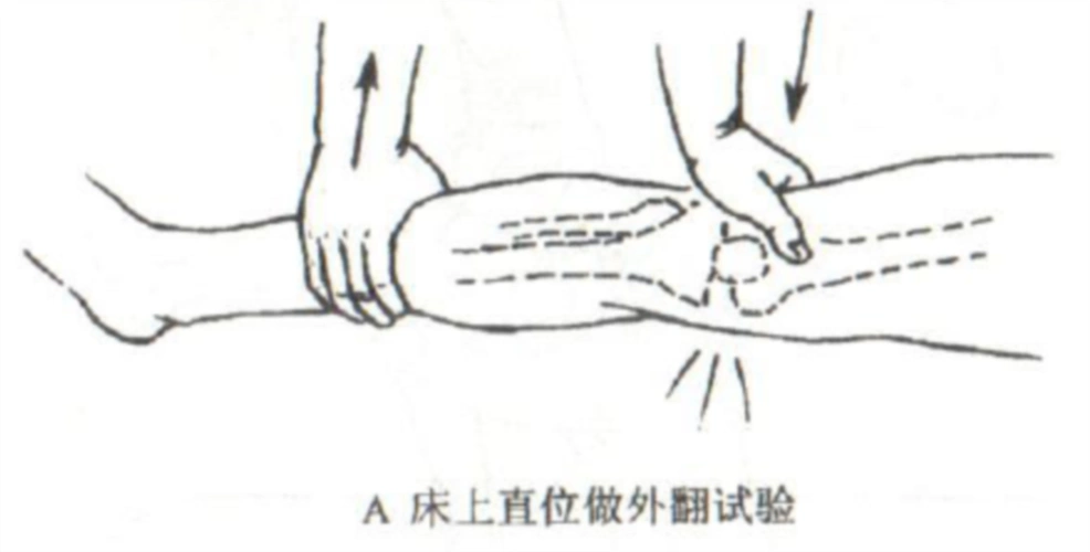 侧方牵拉试验:膝关节伸直位放松,一手固定小腿,一手固定股骨远端,固定
