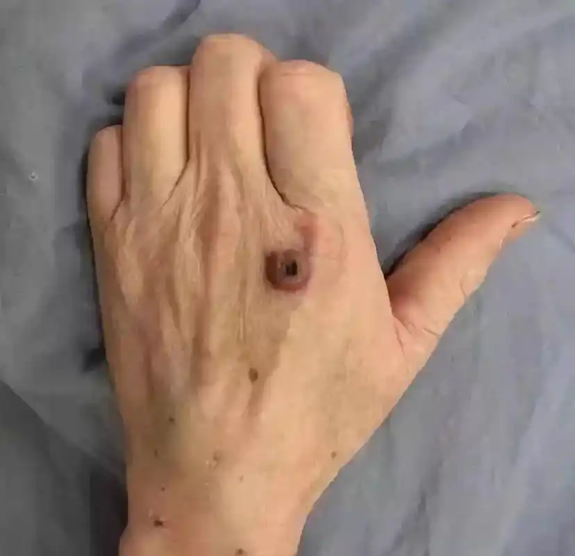 封丘人疯传的炭疽病到底是什么?真那么可怕吗?