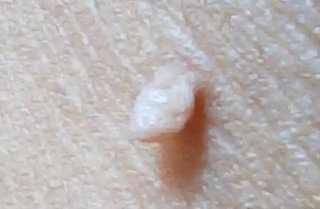 hpv病毒又叫做人乳头瘤病毒,分为高危型和低危型,hpv病毒6型和hpv病毒